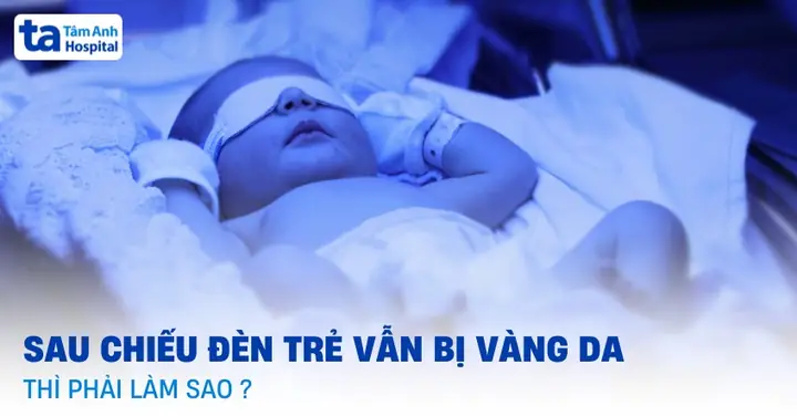 Chiếu Đèn Vẫn Bị Vàng Da