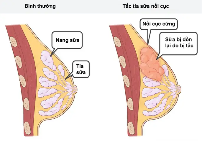 Cách Chiếu Đèn Hồng Ngoại Chữa Tắc Tia Sữa
