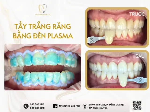 Review Tẩy Trắng Răng Bằng Đèn Plasma