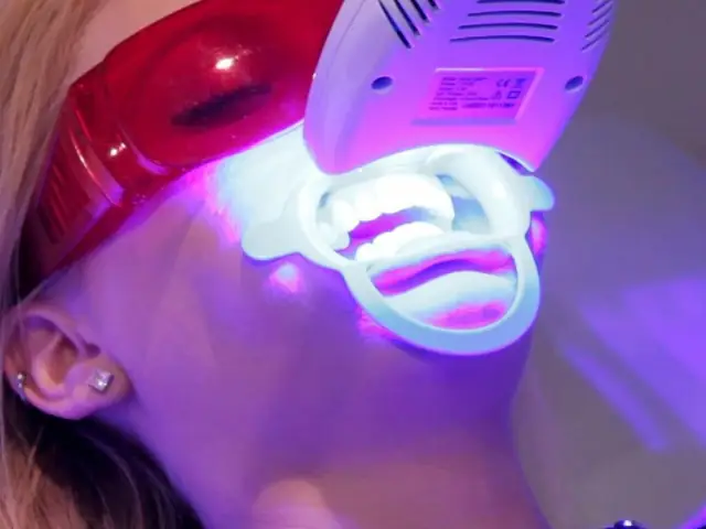 Review Tẩy Trắng Răng Bằng Đèn Plasma